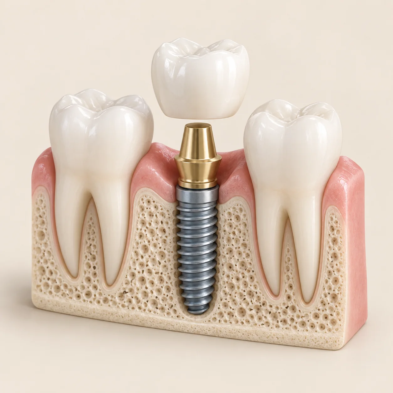 Ilustración de un implante y su corona, entre dos dientes